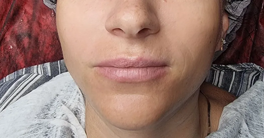 before-after