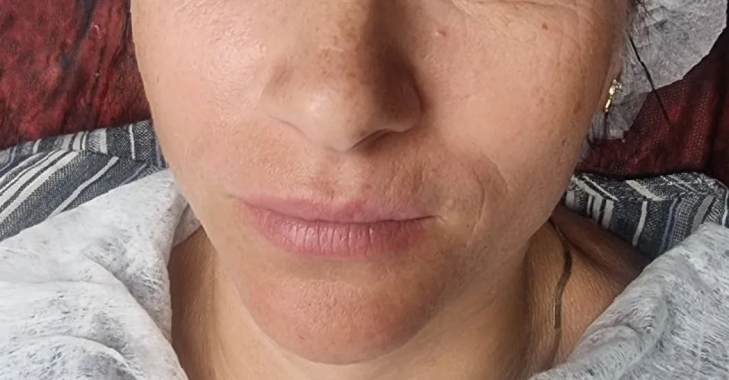 before-after
