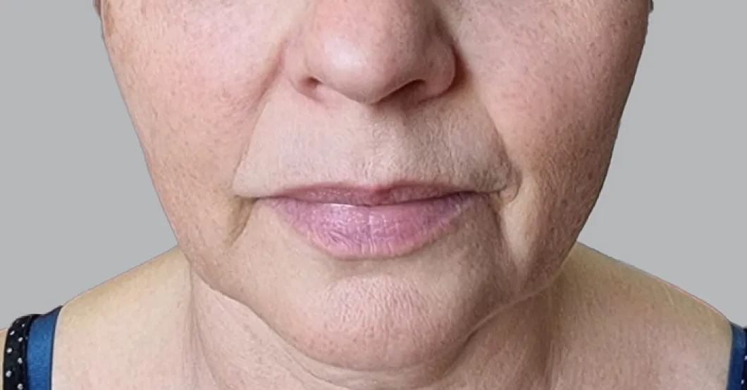 before-after